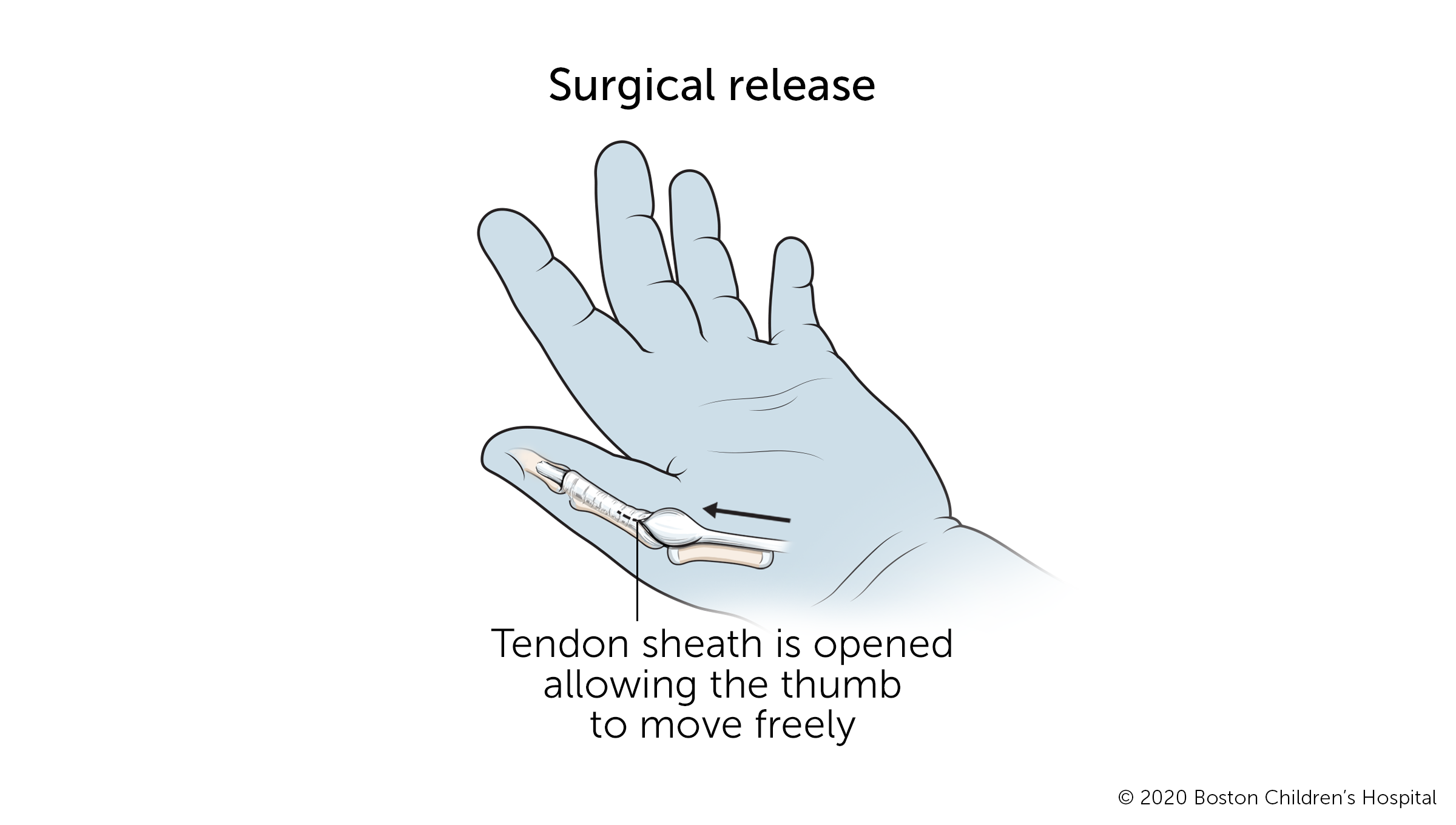 触发拇指:在手术过程中，肌腱周围的鞘被打开，以允许拇指自由活动。