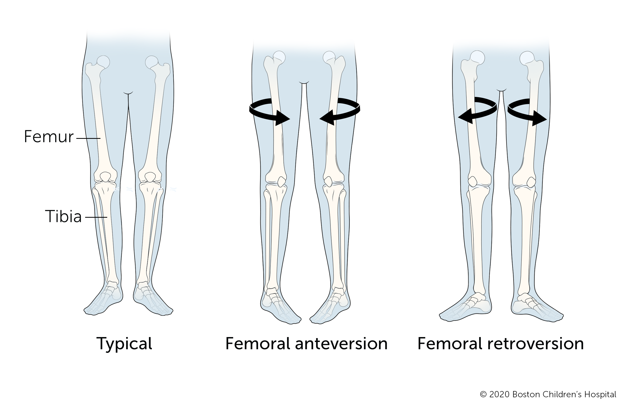 典型的腿，股骨前倾的腿和股骨后倾的腿。