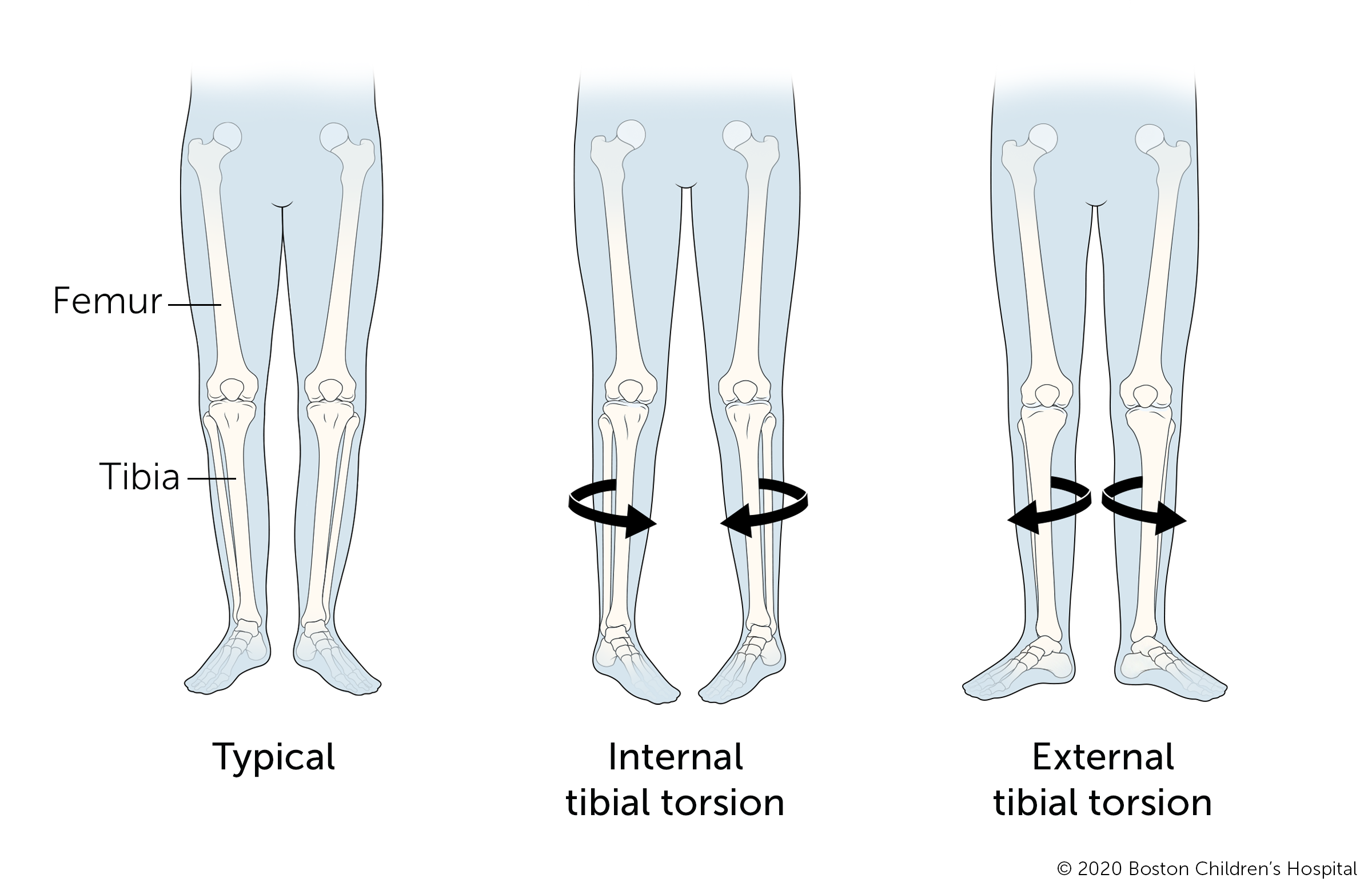 胫骨正常1例，胫骨内扭转1例，胫骨外扭转1例。
