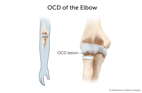 肘关节剥脱性骨软骨炎，肘关节的一段骨与其他骨分离。