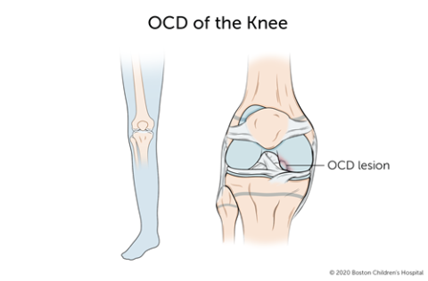 膝关节剥脱性骨软骨炎，膝关节的一段骨与其余骨分离。
