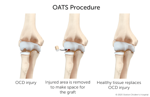 燕麦手术通过从体内其他地方取的健康组织代替受伤的骨骼和软骨来修复骨软骨炎。